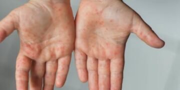 La viruela del mono, un virus que preocupa a la OMS