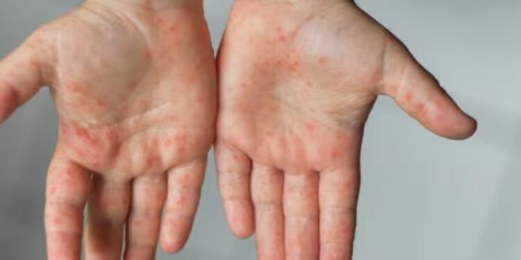 La viruela del mono, un virus que preocupa a la OMS